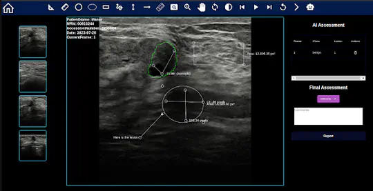 Computer-Aided System for Breast Cancer Lesion Segmentation and Classification Using Ultrasound Images