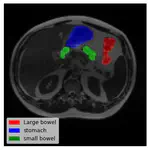 GI-Tract-Image-Segmentation